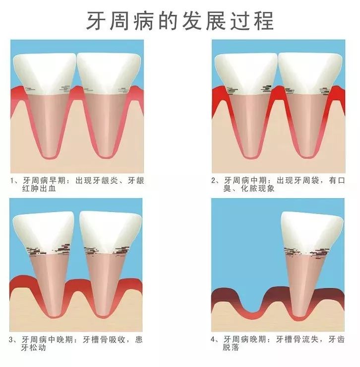 当牙根周围的牙槽骨因为某些原因(如长期的牙周病)而逐渐