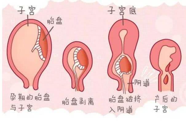 产后子宫恢复得好不好,重点看恶露和子宫刀口这两个地方