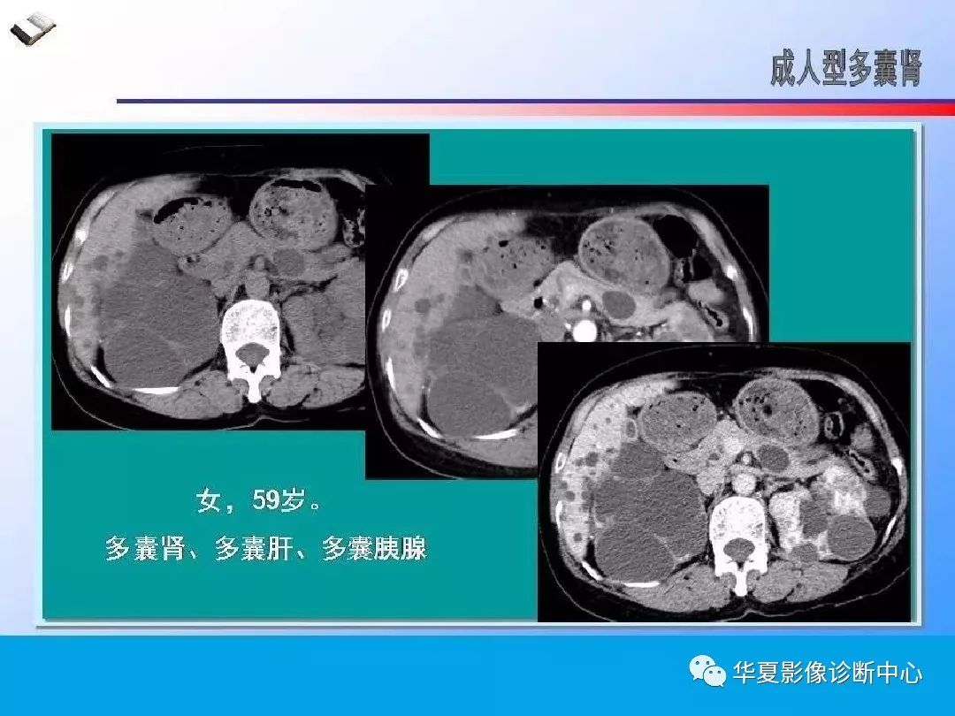 肾脏囊性病变的ct诊断与鉴别诊断