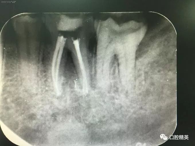 左下第一磨牙牙隐裂 牙髓炎一例
