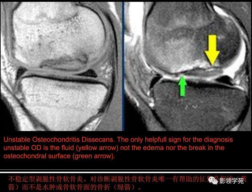 膝关节非半月板病变mri影像诊断