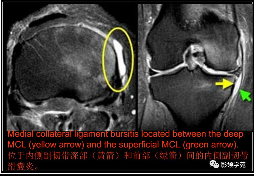 膝关节非半月板病变mri影像诊断