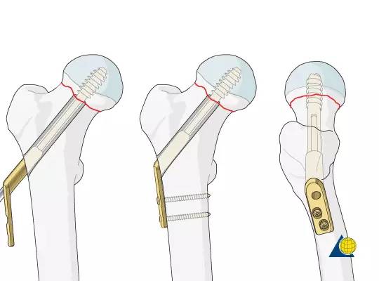 有些简单的股骨颈骨折也不能用空心钉固定