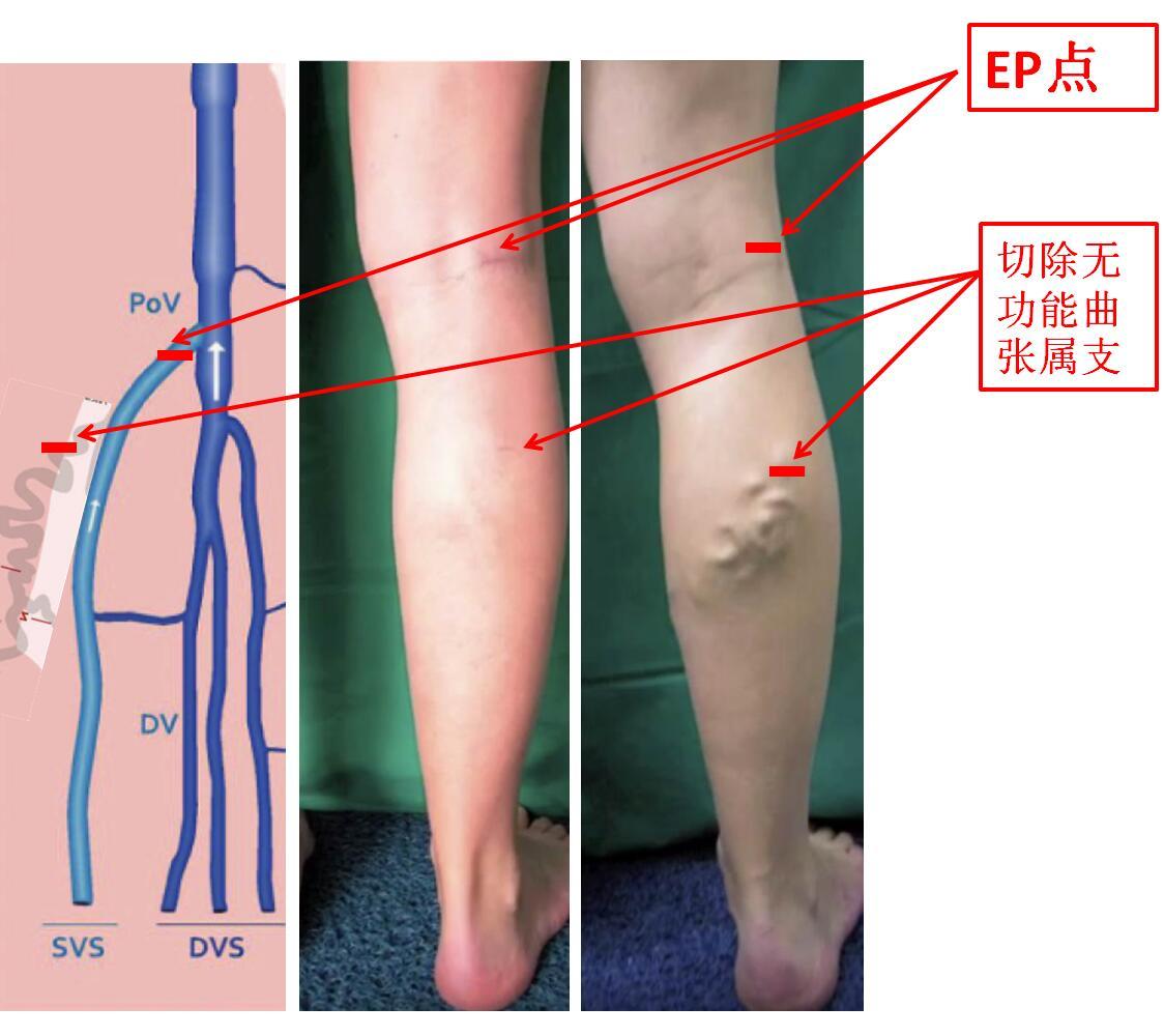 chiva传奇:下肢静脉曲张的极致微创手术,保留大隐静脉