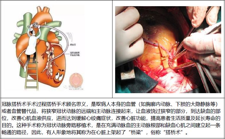 2,什么是冠状动脉搭桥术 责任编辑