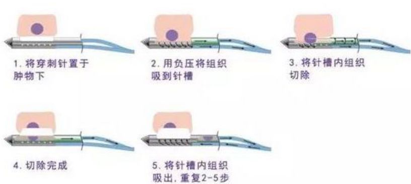 乳腺微创旋切术工作原理