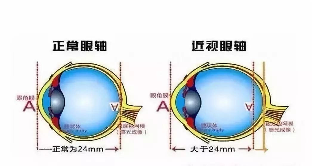 近视眼老了不会得老花眼?_眼睛