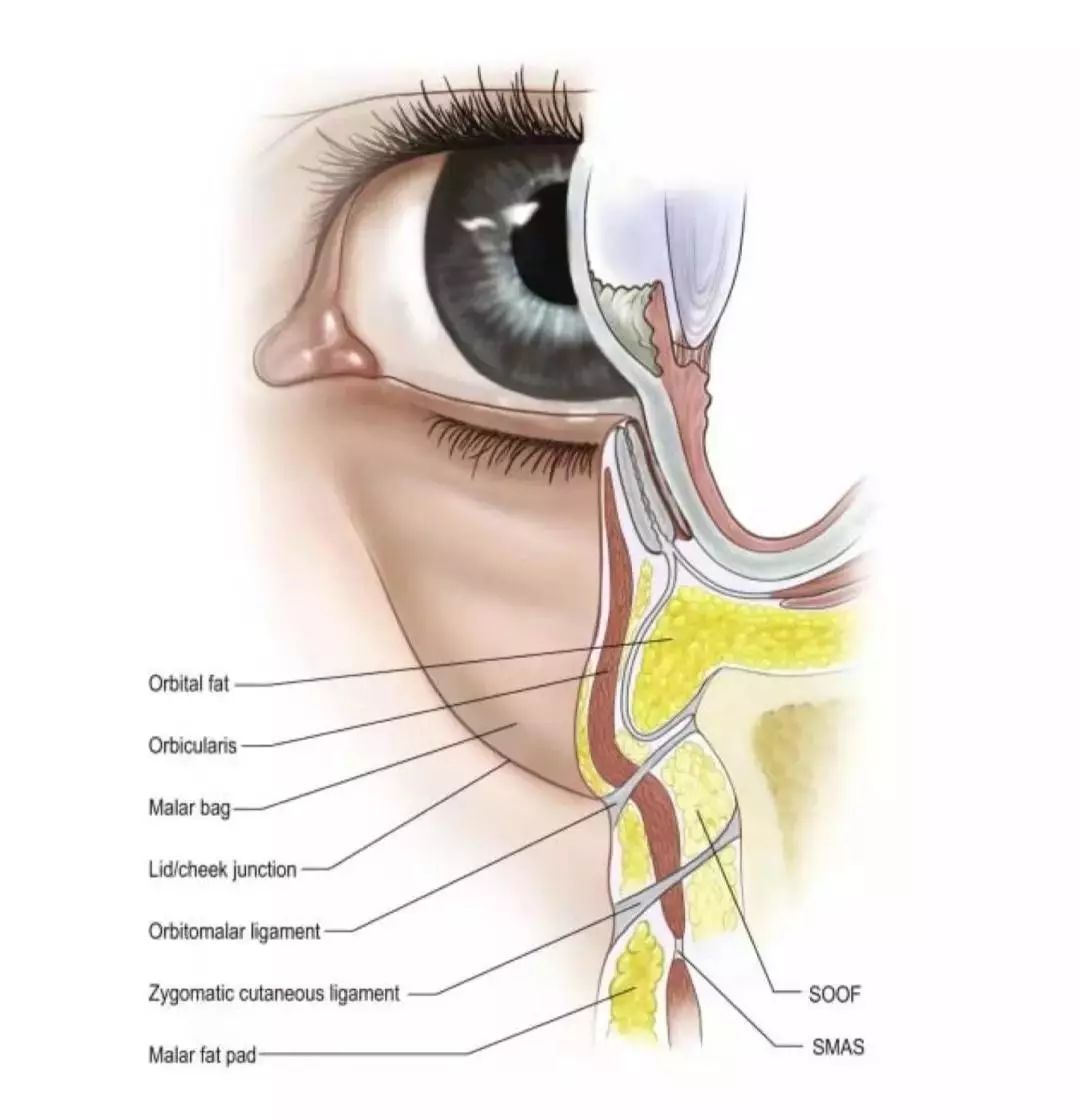 泪沟上方眶隔脂肪的膨出,以及眼轮匝肌下方的脂肪(soof,面深层脂肪垫)