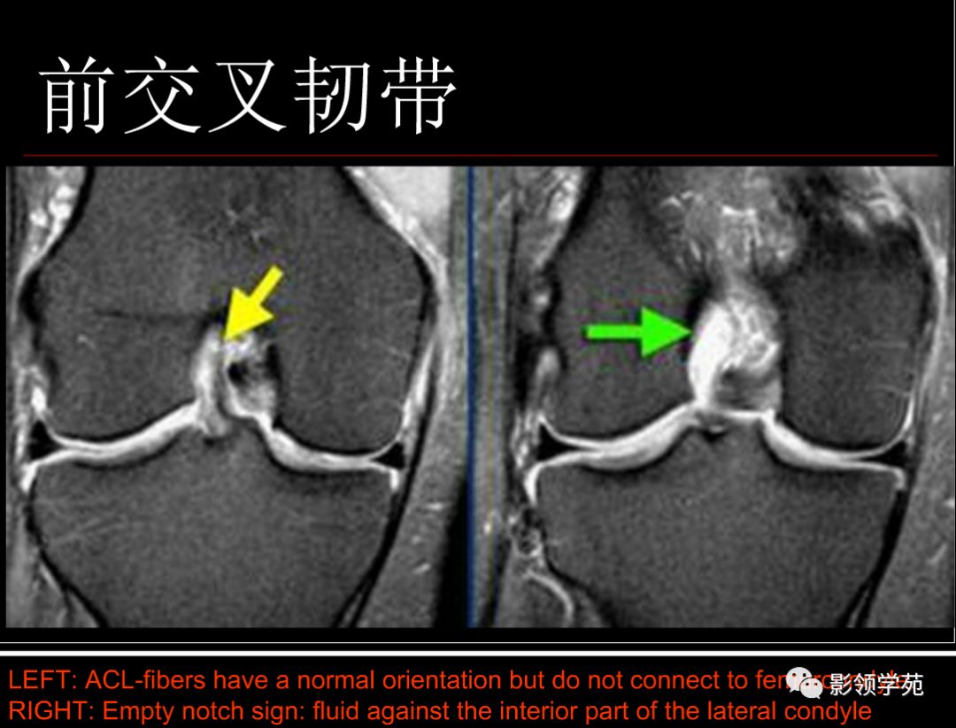 膝关节非半月板病变mri影像诊断