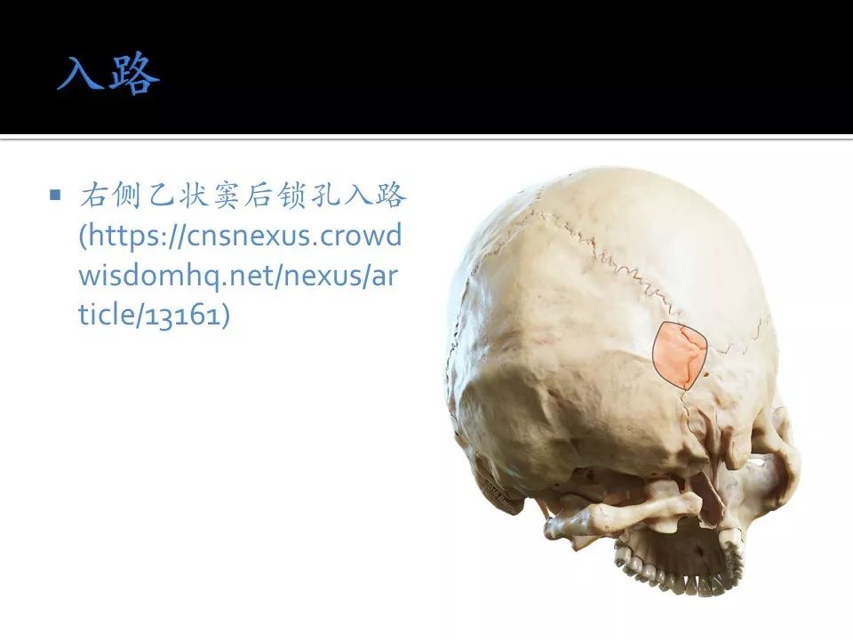 nexus精选病例丨第一期内镜辅助下右侧乙状窦后入路三叉神经减压术