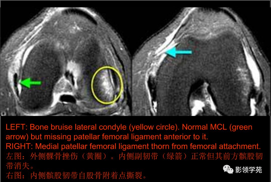 膝关节非半月板病变mri影像诊断