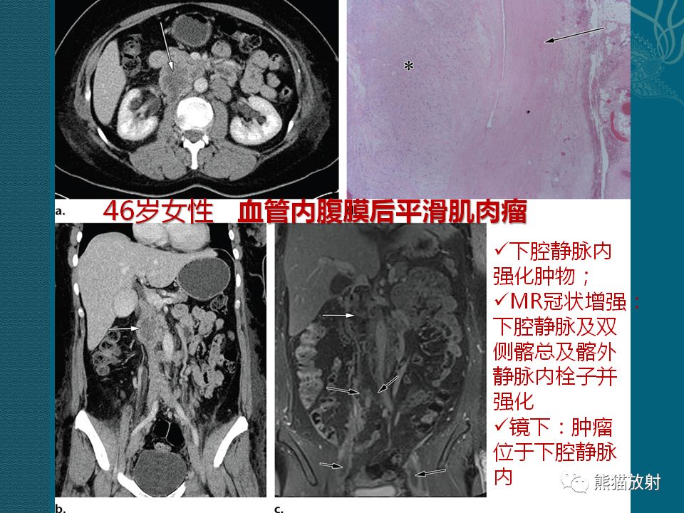 腹膜后平滑肌肉瘤丨诊断及鉴别诊断