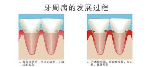 3,坏死性龈病.