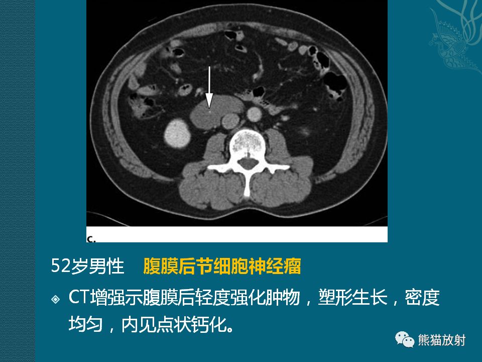 腹膜后平滑肌肉瘤丨诊断及鉴别诊断