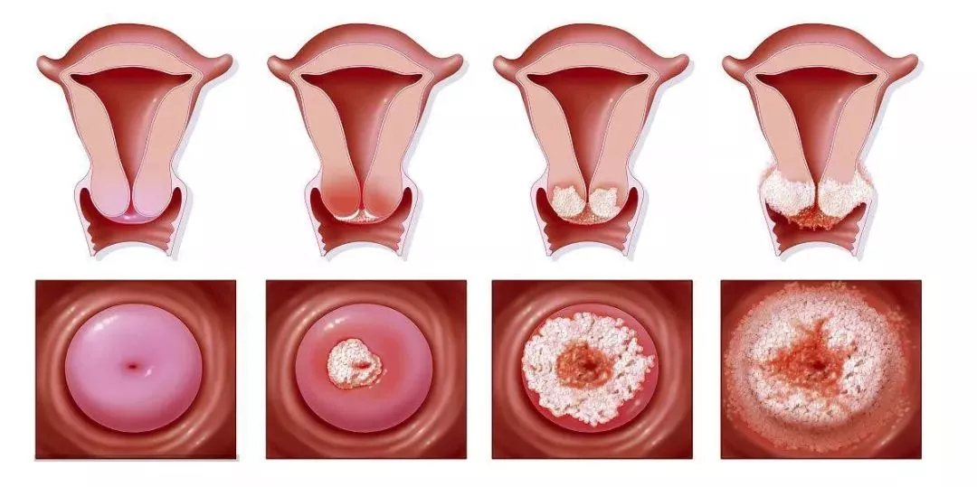 宫颈疾病都有什么症状?这里就要敲黑板了,为什么总是反复发作?