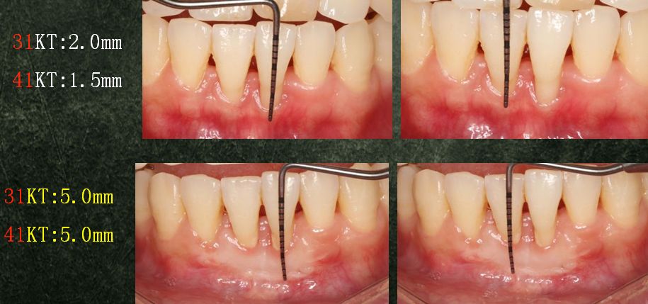 角化龈宽度均增加至5mm膜龈联合的位置下移基础治疗20个月后牙周状况
