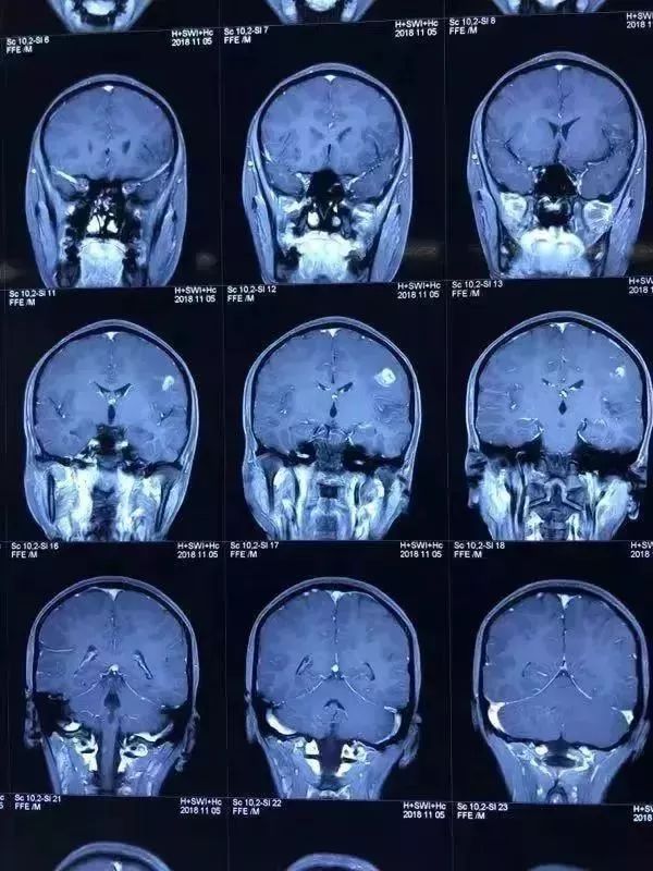 10多年前,我们曾接诊类似的案例,依据经验,怀疑是寄生虫特异性感染.