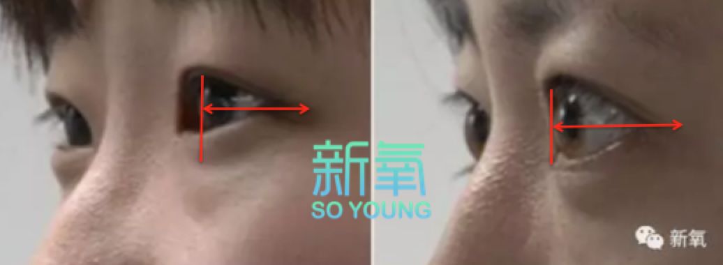一般来说,亚洲人的正常眼球突出度在10-14m,平均在13mm左右,如果眼球