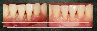 4mm出血:22%溢脓:0牙龈退缩:14 teeth根分叉病变:0松动:0菌斑:21%约98