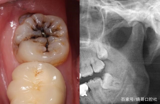 牙齿疼得要命怎么办