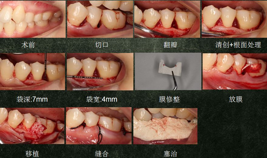 遇到局限型侵袭性牙周炎的患者,你会这样做吗?