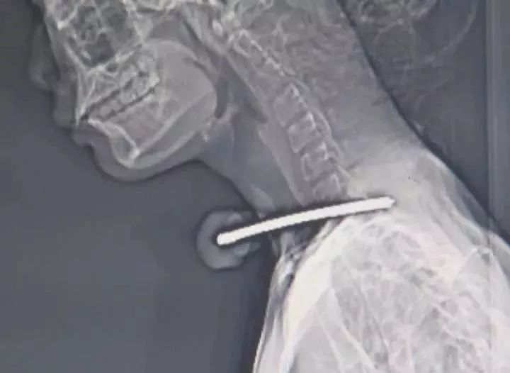 惊悚!龙川一男子被螺丝刀插入自己体内10多厘米.