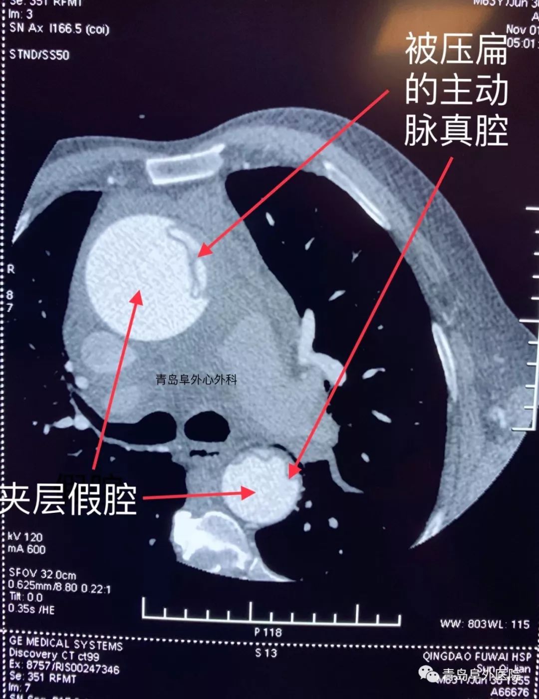 撕裂生命的主动脉夹层图文