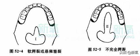 单纯性腭裂包含两种情况:软腭裂(大家用舌头顶一下上颚靠近嗓子眼的