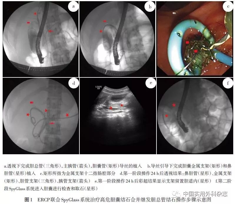 论著ercp联合spyglass系统治疗高危胆囊结石合并继发胆总管结石可行性