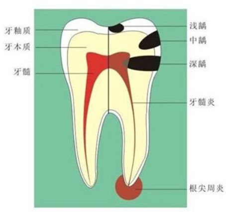 小孩牙龈长泡怎么办