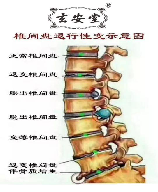 腰椎病—膏药的正确贴法