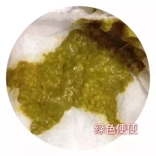 如果孩子大便次数多,呈水样或者鸡蛋汤样,毫无疑问,这就是宝宝腹泻了