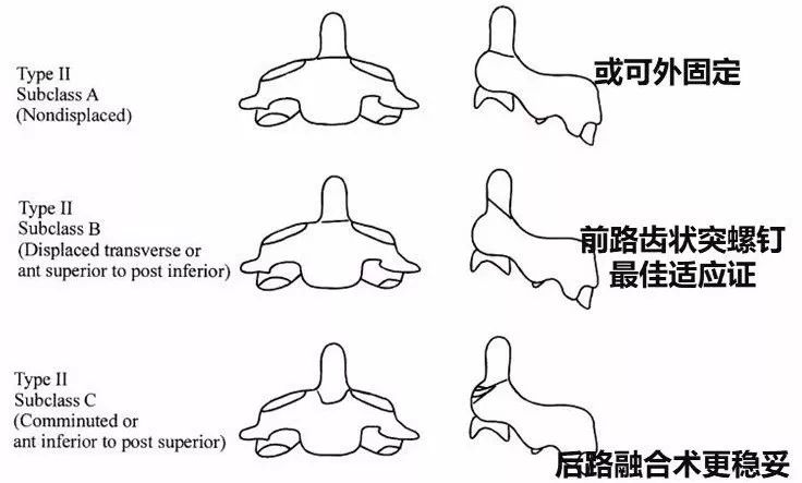 罕见齿状突骨折合并强直性脊柱炎病例的诊治