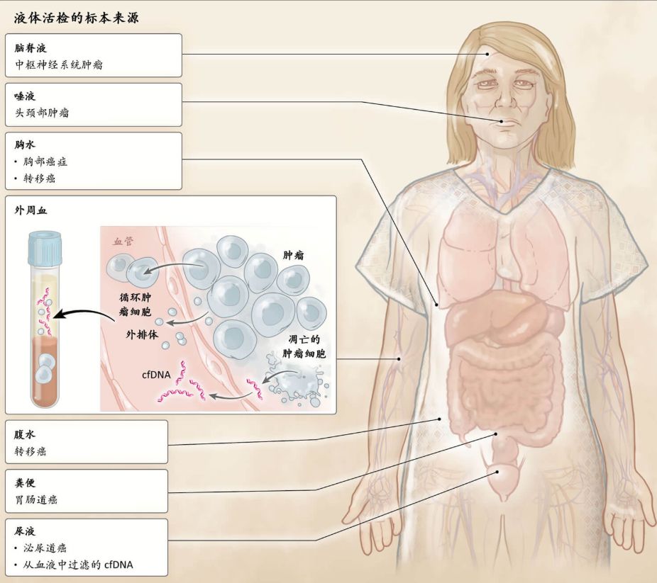 液体活检—肿瘤早筛及术后管理