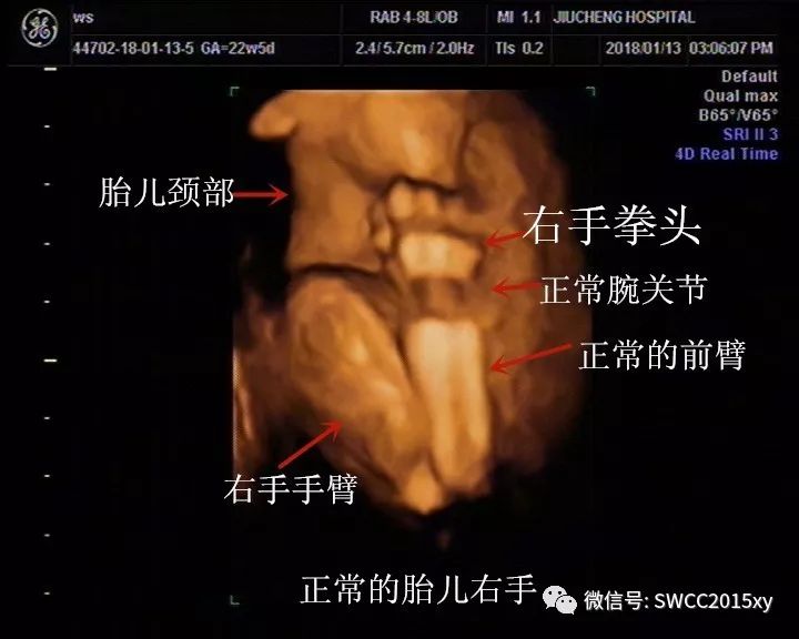 看下图:这个是胎儿的右手,右手呈半握拳状,手型自然,腕关节呈低回声