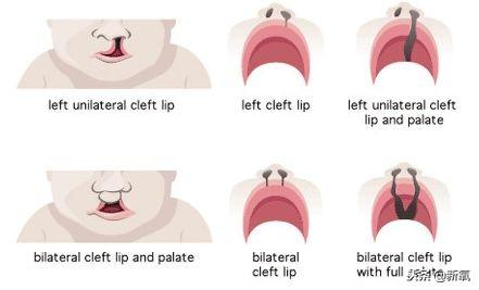 完全性唇腭裂既要解决裂开的上颚,又要重点关注唇形的修复,颜面的美观