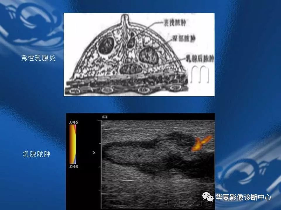 乳腺解剖及常见疾病的诊断