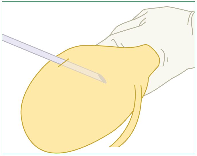 膀胱穿刺术