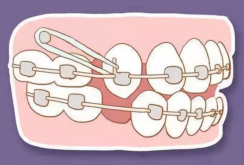 【微健康】为什么要矫正牙齿?专家权威解答.