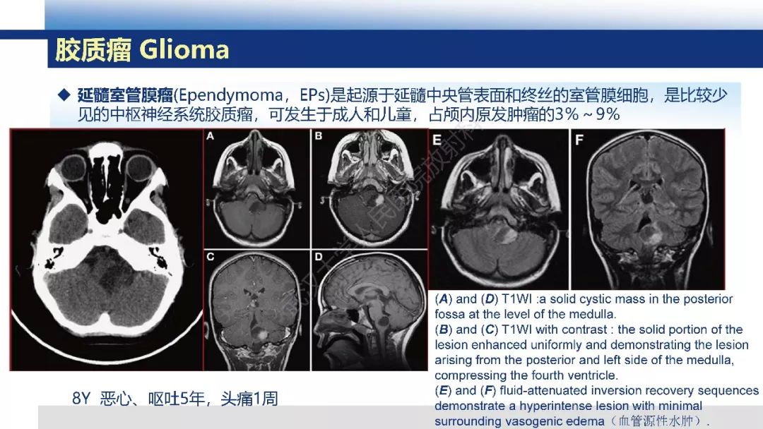 延髓肿瘤及肿瘤样病变影像诊断