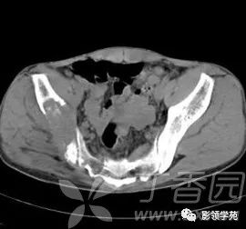 多发性溶骨性病变的影像学诊断