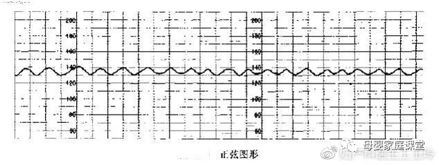 胎心监护你看懂了吗