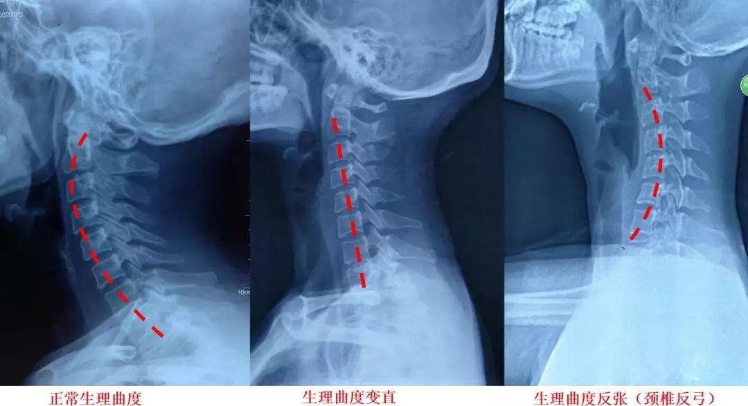 颈椎病人口_颈椎病的症状图片(3)