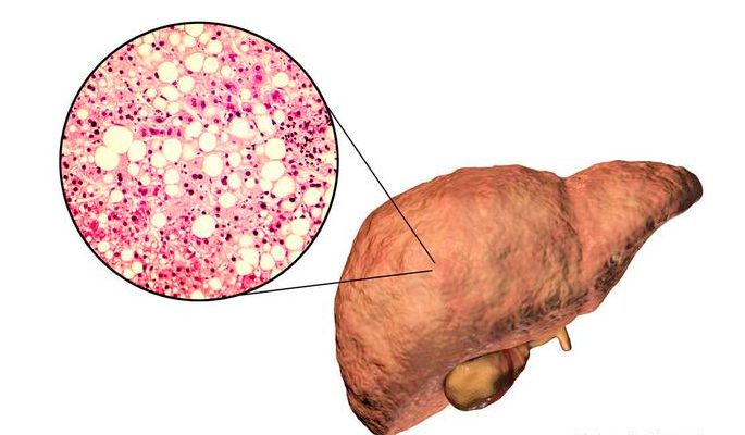 脂肪肝者出现3大迹象需警惕肝要硬化莫忽视