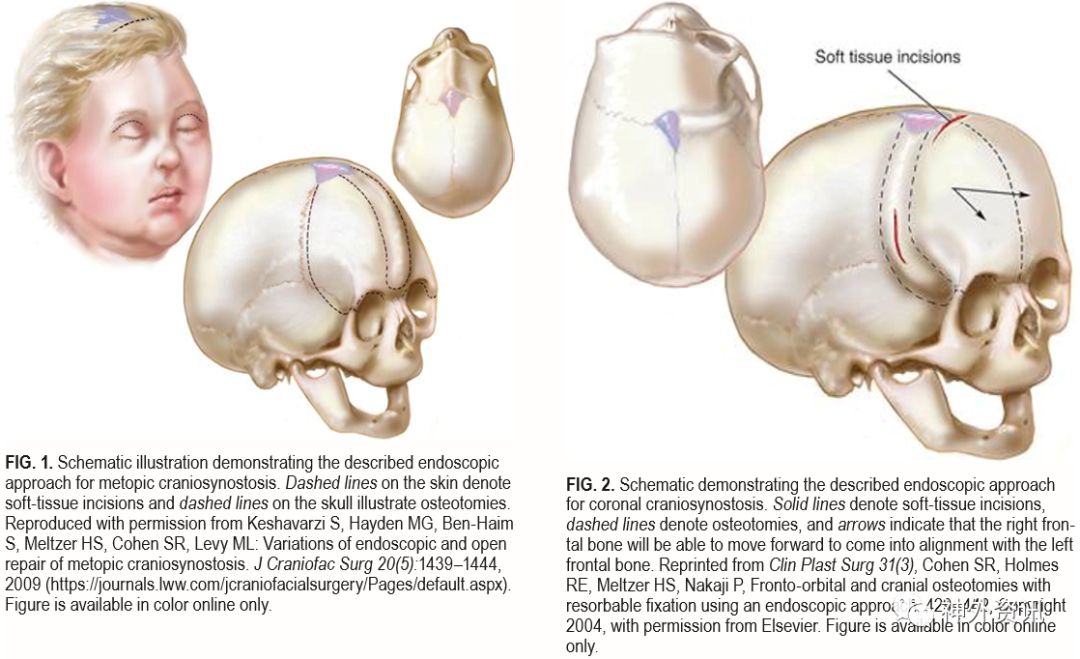 3 仰卧位下微创矢状缝早闭颅骨切除术:技术说明