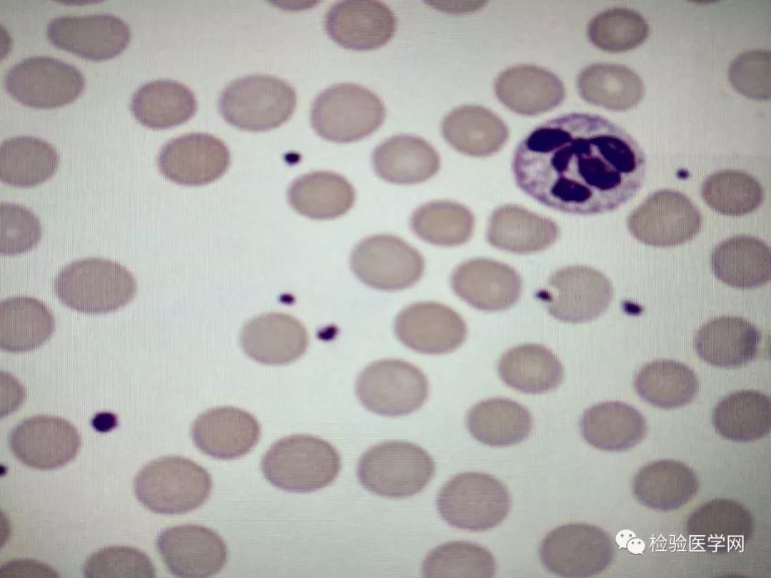 这次的血小板形态正常了,可以断定上次看到的血小板其实是乳糜微粒.