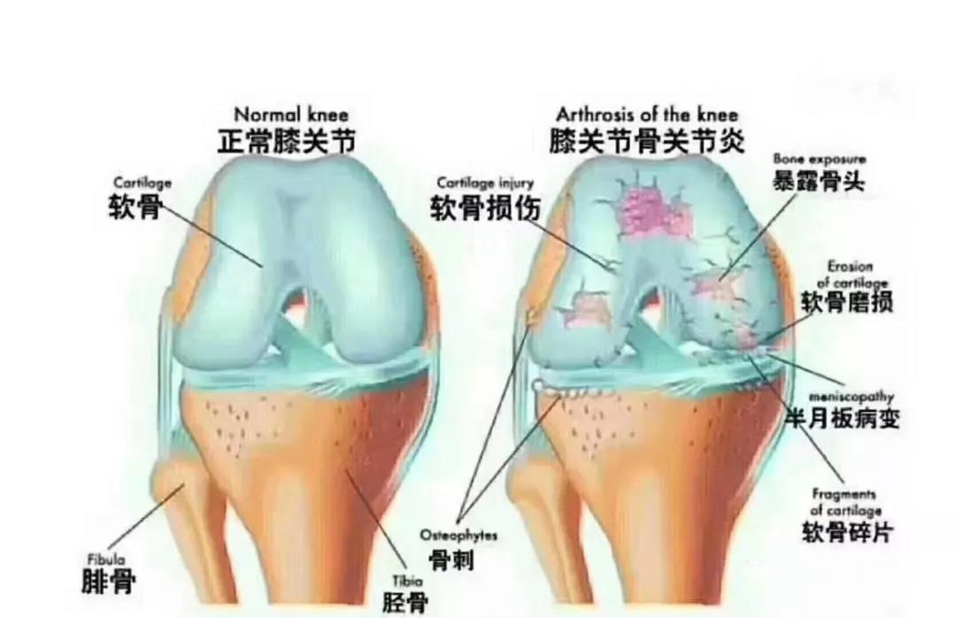 病因:一,在老年人多继发于膝关节骨关节炎,主要是因软骨退变与骨质