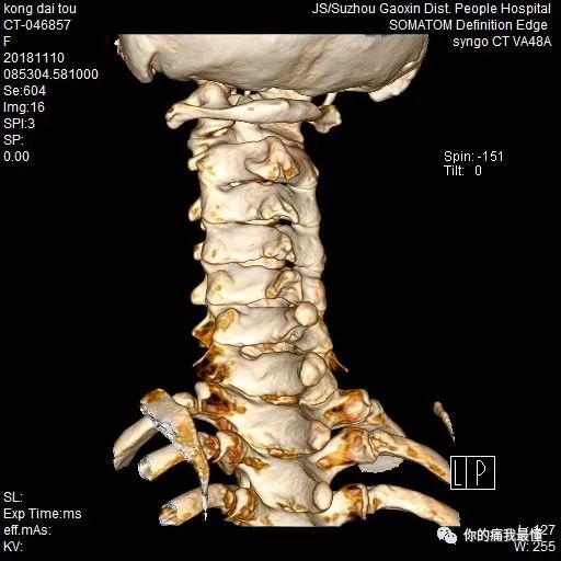 高新区首例全脊柱内镜下经颈椎后入路椎板减压髓核摘除术获得成功