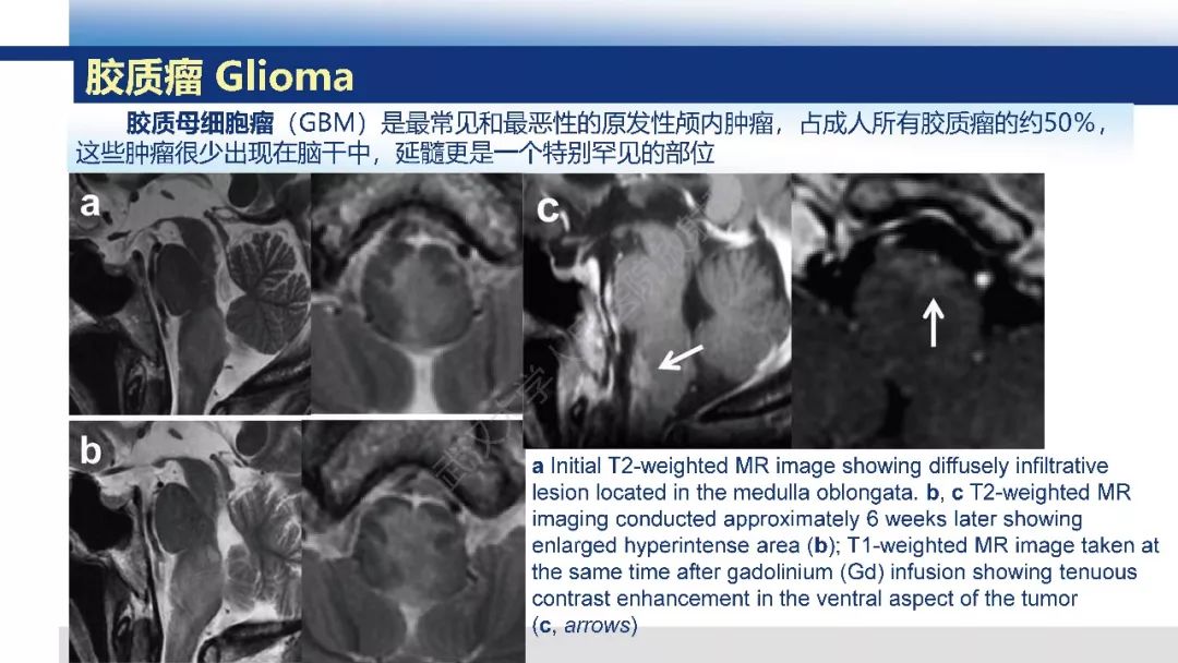延髓肿瘤及肿瘤样病变影像诊断