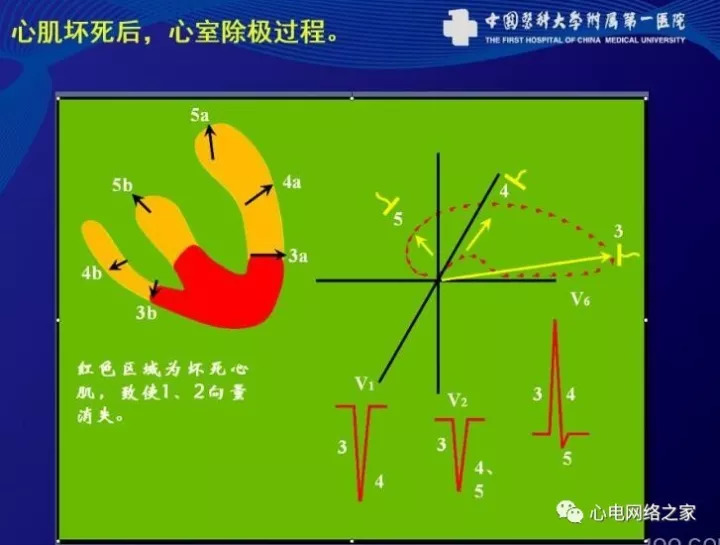 【王永权老师系列之二十六】心肌梗死心电图诊断